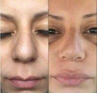 Plastic Surgery Nose In Beverly Hills Preop And Postop Pic