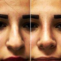 Plastic Surgery Of Nose In Portland, Oregon Before And After