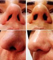 Plastic Surgery Of Nose In Toronto Is Mainly Carried Out Under General Anaesthesia