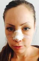 Plastic Surgery On The Nose In London Bump Correction