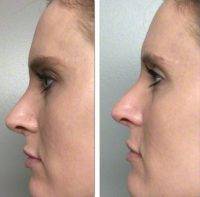 Plastic Surgery Rhinoplasty In The Bronx Preop And Postop Photos