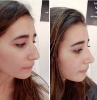 Procedure Of Rhinoplasty In London Before And After Photo