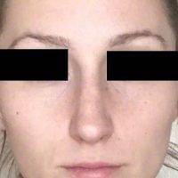 Rhinoplasty For Different Types Of Noses Cost In New York, US