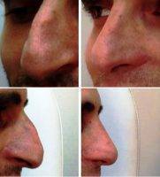 Rhinoplasty For Man In Las Vegas, Nevada Before And After Photos