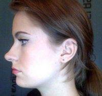 Rhinoplasty Nose Tip Is Performed At The Plastic Surgery Center Of Tampa
