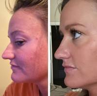 Rhinoplasty On Tip Of Nose Is A Very Challenging And Demanding Surgery In ON, Canada