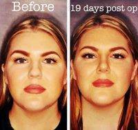 Rhinoplasty Plastic Surgery MA Pic Before And After