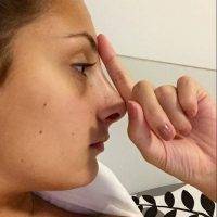 Rhinoplasty Revision In Houston In Order To Achieve Beautiful Results