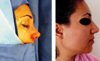 Rhinoplasty San Francisco, CA Before After Images
