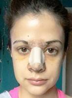 Rhinoplasty Surgery Procedure In Toronto May Be Performed With Local Anaesthetics And IV Sedation