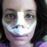 Sacramento Tip Of The Nose Surgery Recovery