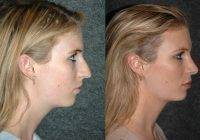 San Antonio, Texas Nose Job Before And After