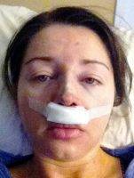Surgery Of The Nose In Miami FL Can Change Your Nose's Overall Size, Tip, Bridge And Nostrils