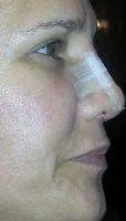Tip Nose Job In St. George for a more pleasing cosmetic appearance