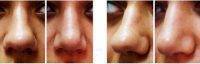 Tip Of The Nose Surgery In Beverly Hills, California Before After