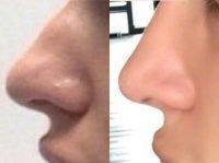 Trenton New Jersey Nose Rhinoplasty Before And After