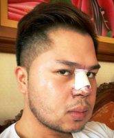 Vancouver Asian Rhinoplasty For Man