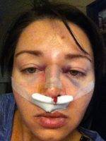 Vancouver, BC Cosmetic Surgery Nose For Noses With Bulbous Or Bulky Tips