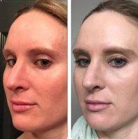 Vancouver Open Rhinoplasty Preop And Postop Images