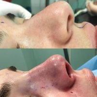 Western Australia Nose Job Before And After Photos