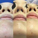 Affordable Rhinoplasty Patient