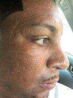 African American Nose Reshaping Rhinoplasty Candidate Pic