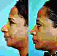 African American Rhinoplasty Nashville, TN Pictures