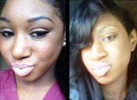 African American Rhinoplasty Surgery Procedure Before And After