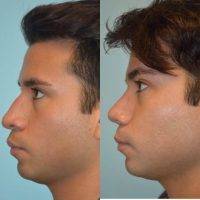 Ankara Turkey Plastic Surgery Tip Of Nose For Man With Metin Kerem