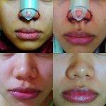 Asian Cosmetic Surgery