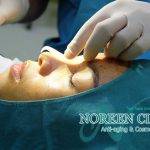 Asian Nose Bridge Surgery