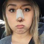 Asian Nose Job Before After (1)