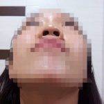 Asian Nose Job Before After (2)