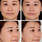 Asian Nose Job Before And After (1)