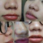 Asian Nose Job Is One Of The Most Popular Cosmetic Surgery Procedures In Dr. Oleh Slupchynsky's medical practice