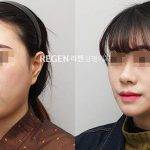 Asian Nose Rhinoplasty Before After Photos