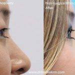 Asian Nose Rhinoplasty Pictures