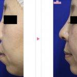 Asian Nose Surgery Before And After (4)