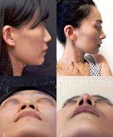 Asian Nose Surgery New Jersey Patient