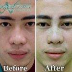 Asian Rhinoplasty Before After (2)