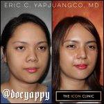 Asian Rhinoplasty Before After (3)