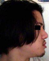 Asian Rhinoplasty Images For Wide Or Round Tip