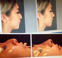 Asian Rhinoplasty OKC Images Before And After Correcting Nose Width At The Bridge