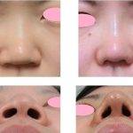 Asian Rhinoplasty To Alter The Width, And The Flare Of The Nostrils