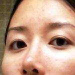 Attractive Asian Nose After Cosmetic Surgery