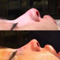 Beauty Nose Surgery For Asian Before And After