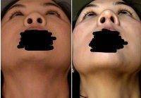 Before And After Asian Beauty Nose Surgery In Calgary, AB Pics