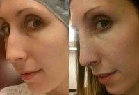 Before And After Canada Nose Beauty Surgery