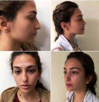 Before And After Canada Rhinoplasty On Tip Of Nose