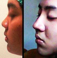 Before And After Korean Nose Surgery In Bangkok